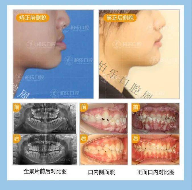 马德隆畸形最新治疗技术与方法探讨