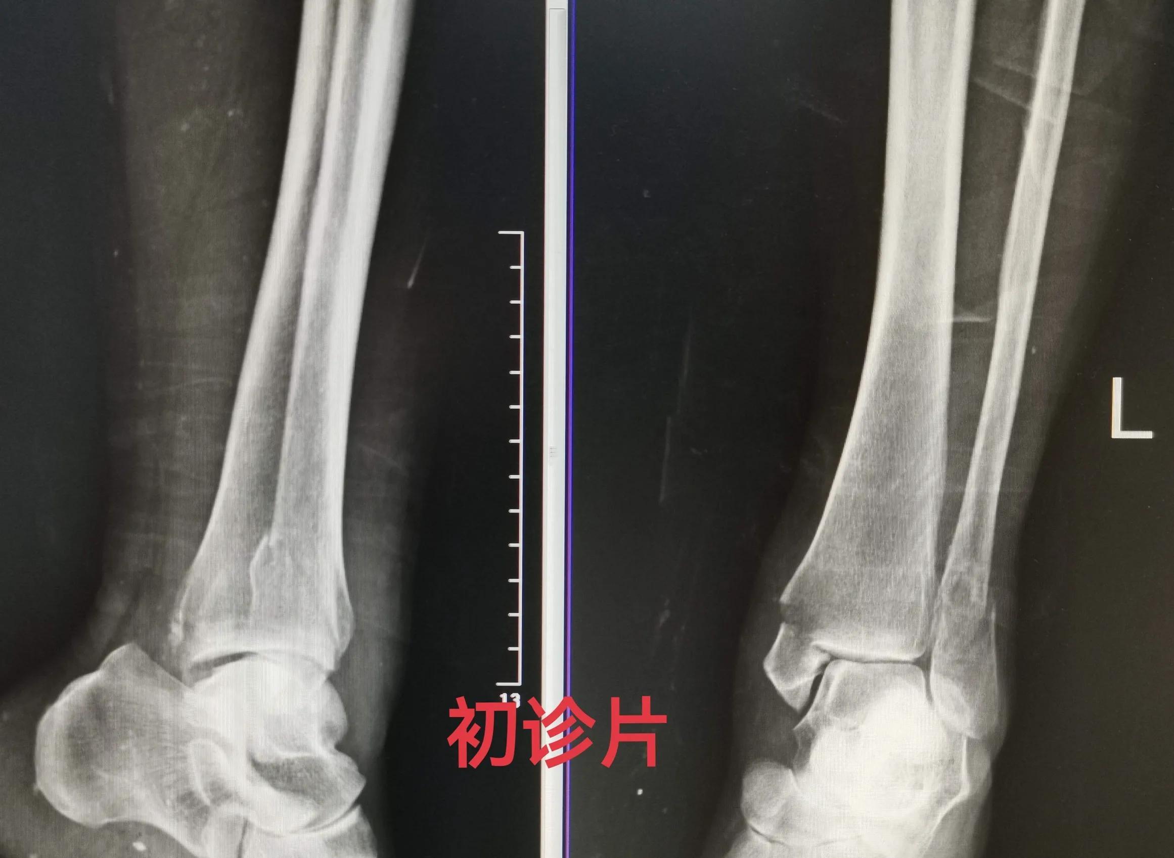 最新骨折治疗进展与策略探索