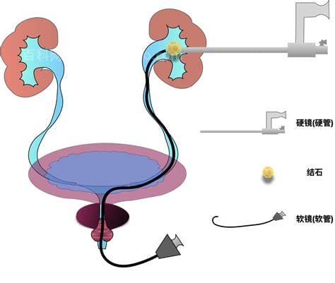 肾结石最新治疗方式，探索与创新突破