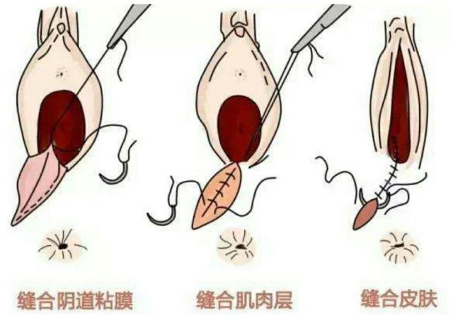 最新侧切技术图解详解与应用须知