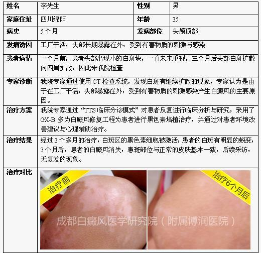 白斑病治疗最新技术，曙光初现的希望之光揭秘