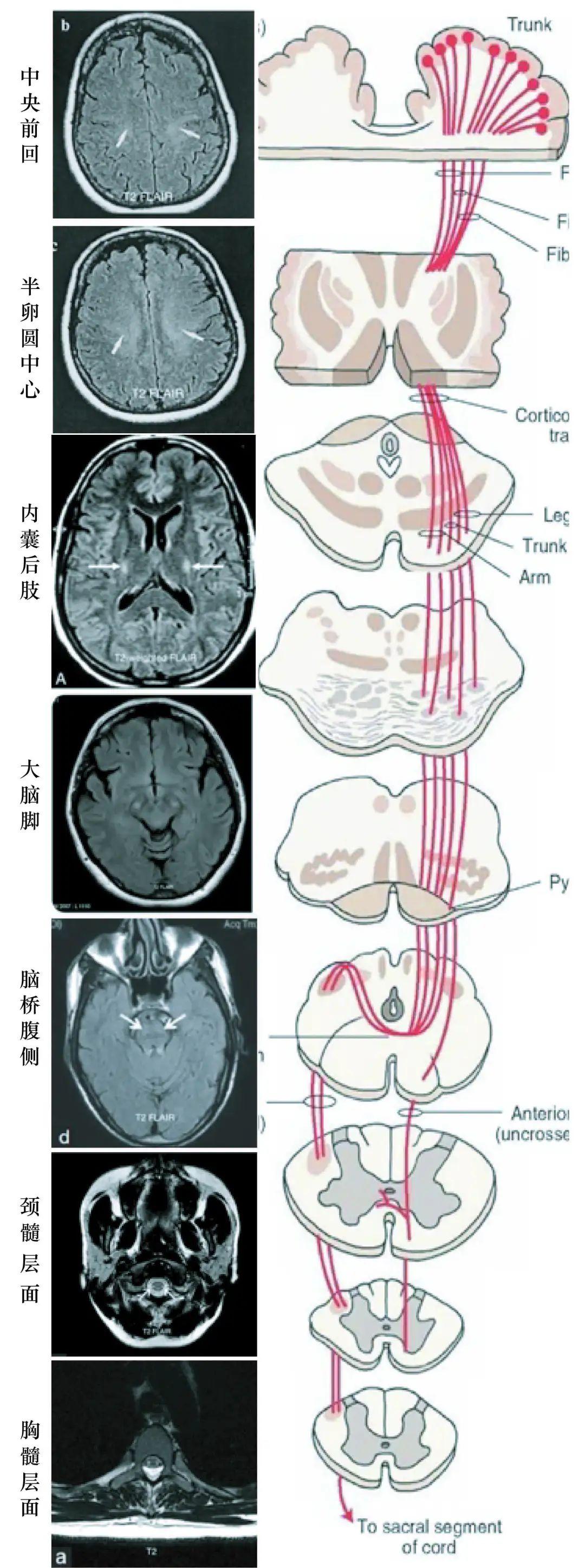 运动神经元最新疗法，突破瓶颈，迎来希望之光