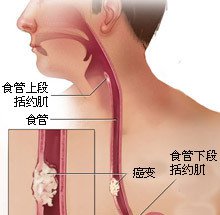 食道癌最新治疗方法概述